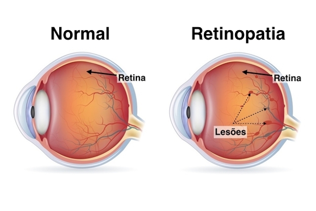 Retinopatia Diabética